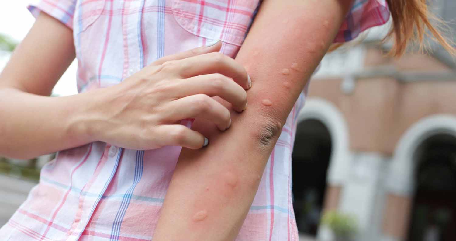 Woman’s arm with multiple mosquito bites